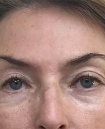 patient after botox