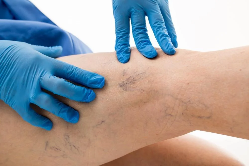 5 Benefits of Sclerotherapy for Spider Veins