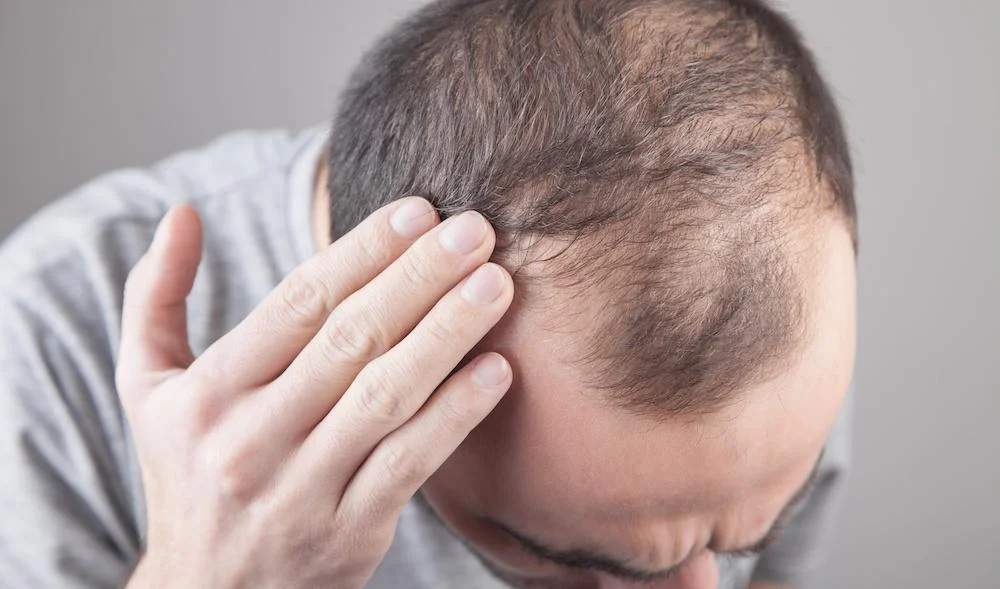 Ways to Restore Hair Loss