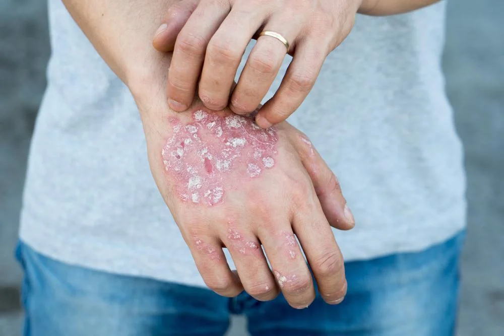Summertime Skin Care Tips for Eczema