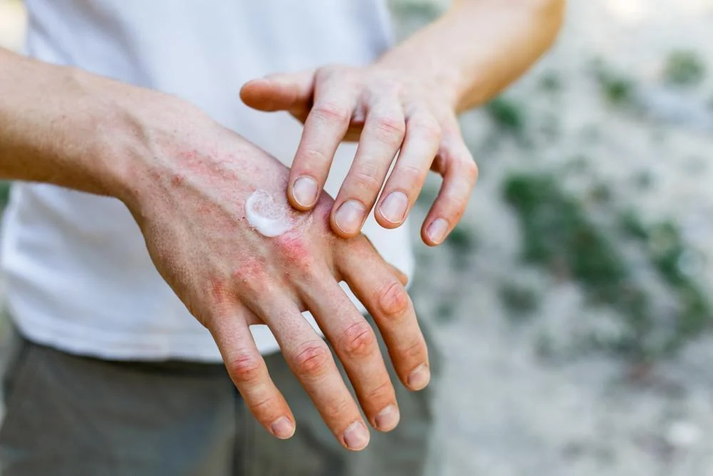 5 Common Eczema Triggers