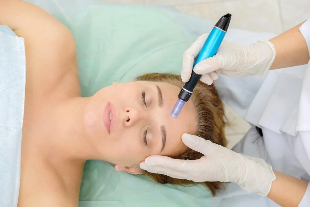 Can Microneedling Help My Acne Scars Disappear?
