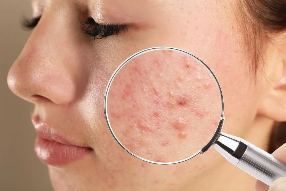 I’m an Adult: Will I Ever Outgrow My Acne?