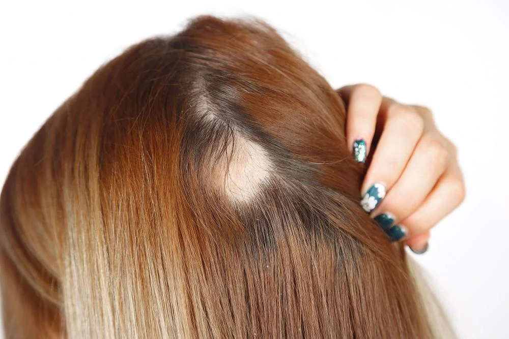 5 Common Causes of Bald Spots