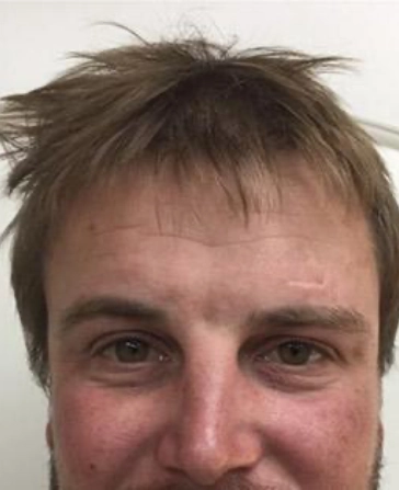 patient before botox