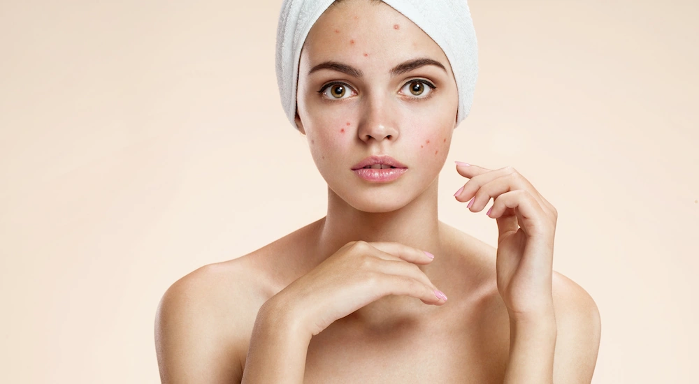 Help! I Have Adult Acne