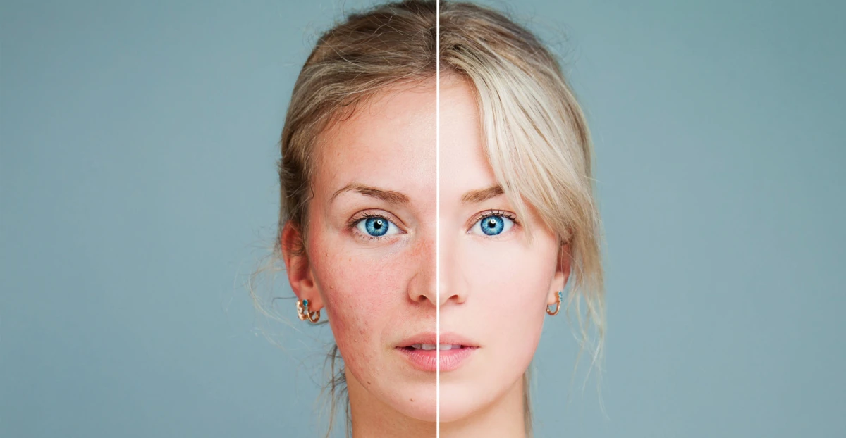 You Don’t Have to Live with Acne — Here’s How to Get Rid of It