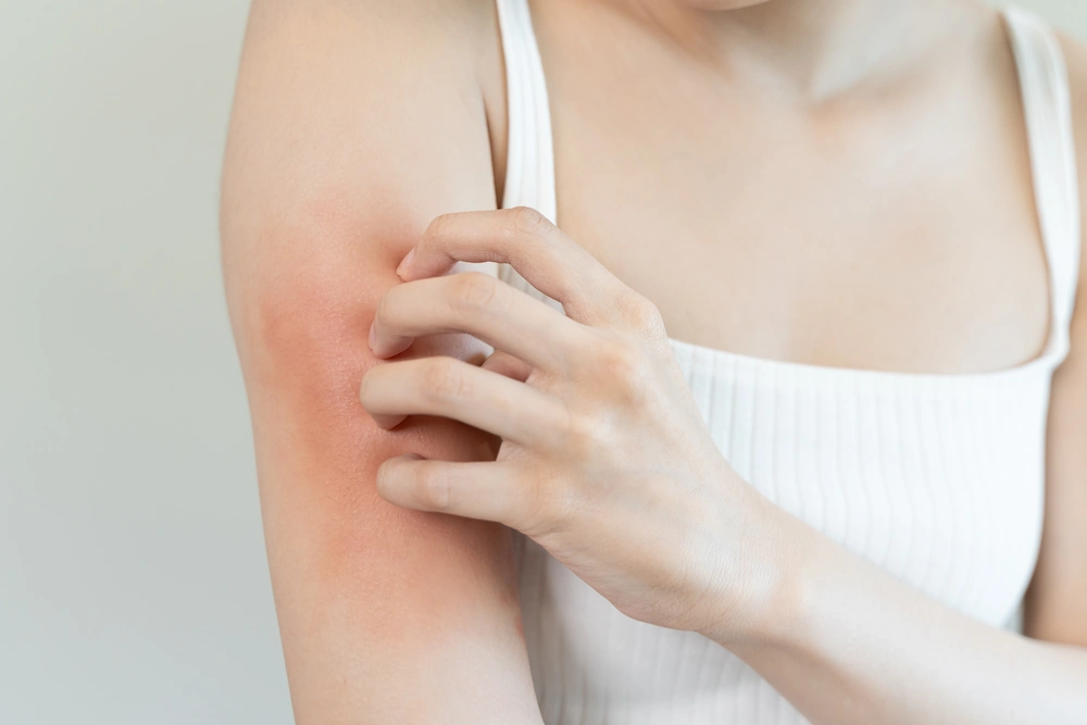 How to Treat Eczema Flare-Ups