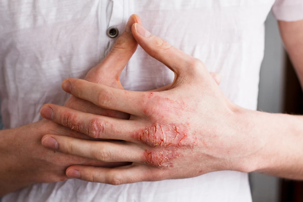 Tips for Avoiding Eczema Triggers