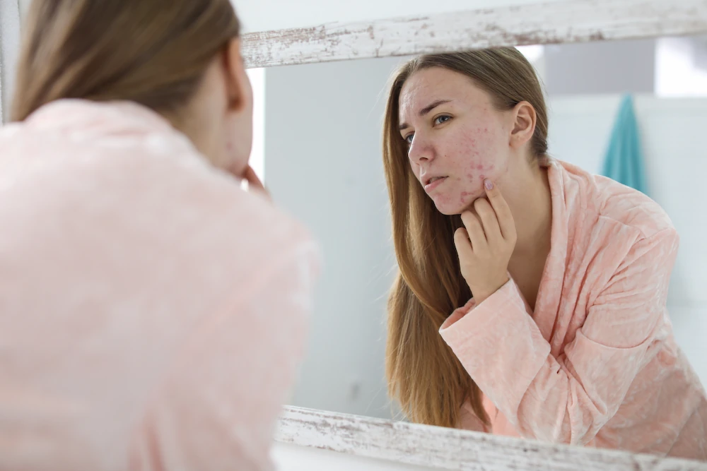 Why Do Adults Get Acne?