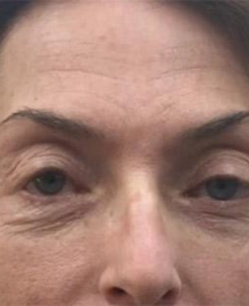 patient before botox