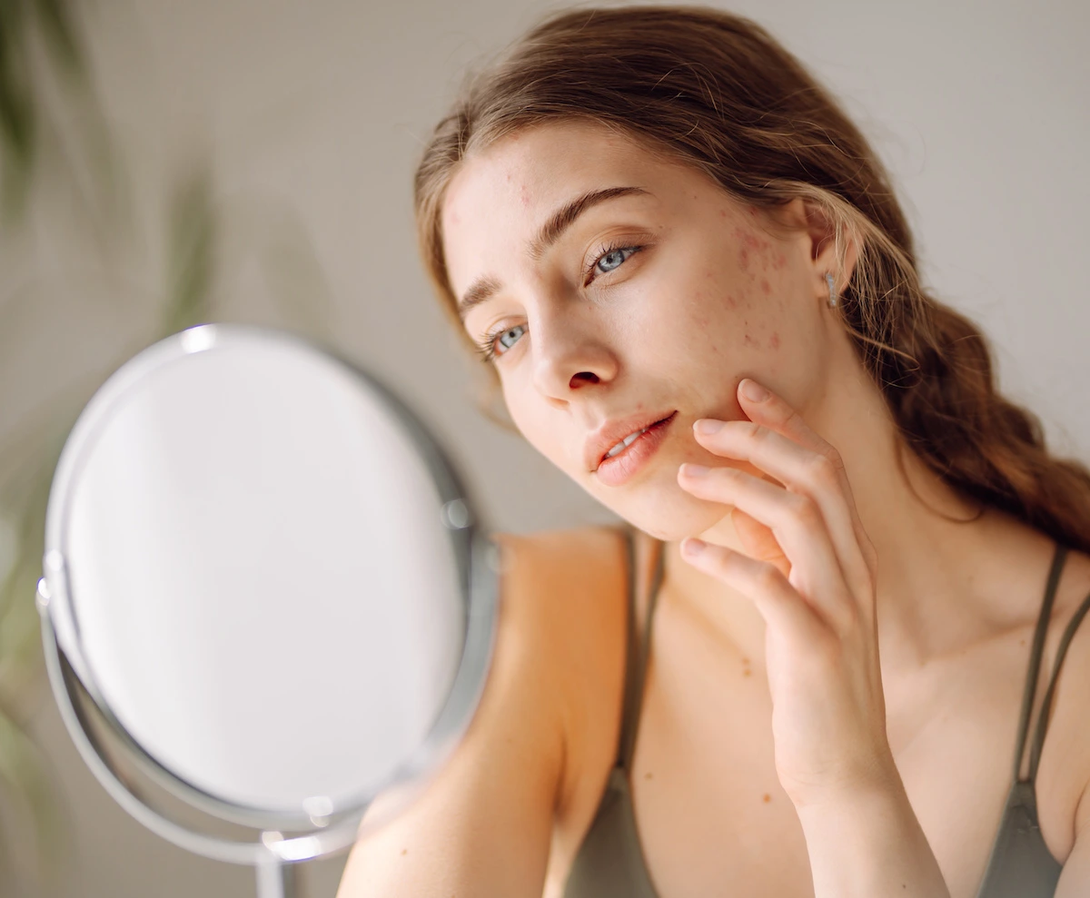 young woman looking at her acne in a mirror