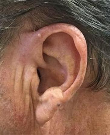 before and after mohs surgery at Plateroti Dermatology