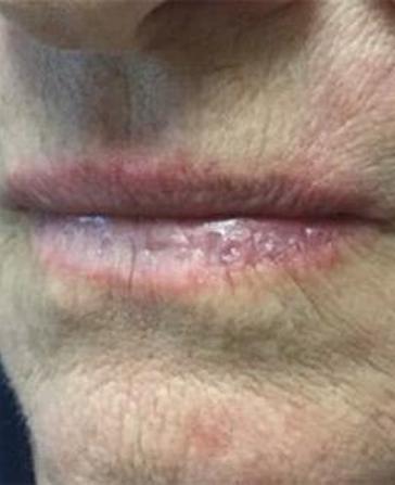 before and after mohs surgery at Plateroti Dermatology