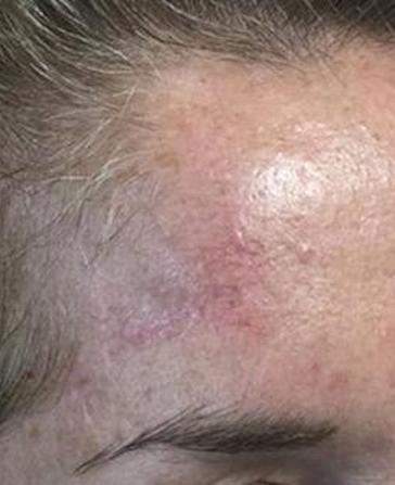 before and after mohs surgery at Plateroti Dermatology