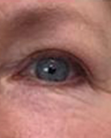 before and after filler