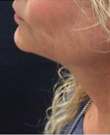 before and after kybella