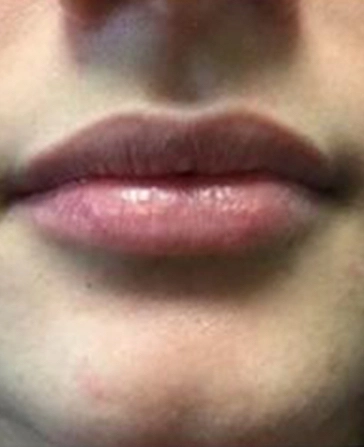 before and after filler