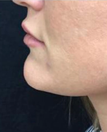 before and after kybella