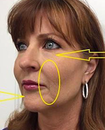 before and after filler