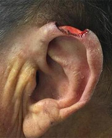 before and after mohs surgery at Plateroti Dermatology