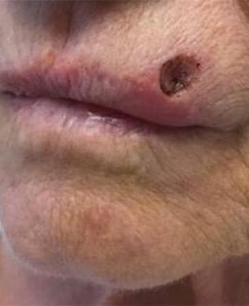before and after mohs surgery at Plateroti Dermatology