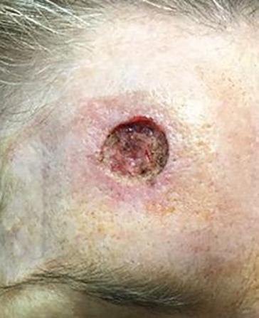 before and after mohs surgery at Plateroti Dermatology