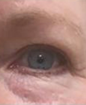 before and after filler