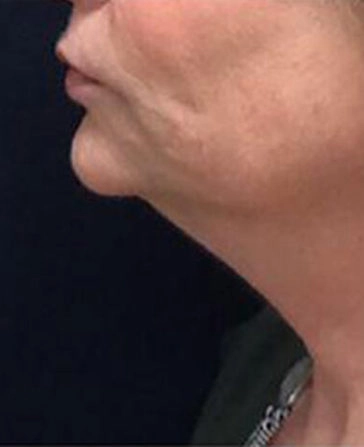 before and after kybella