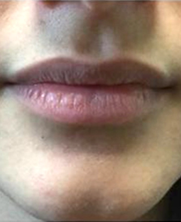 before and after filler