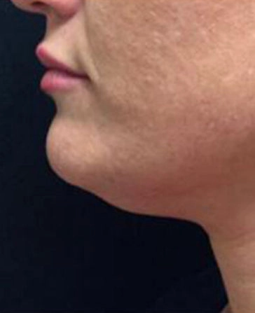 before and after kybella