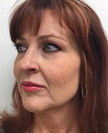 before and after filler