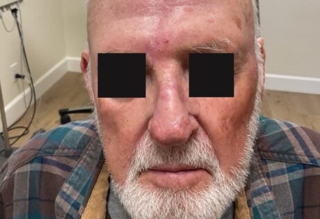 Case # 32 after photo