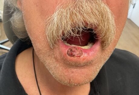 Case # 33 before photo