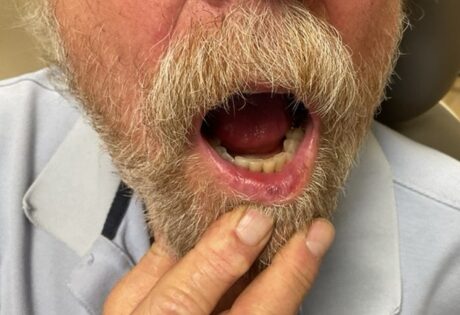 Case # 33 after photo