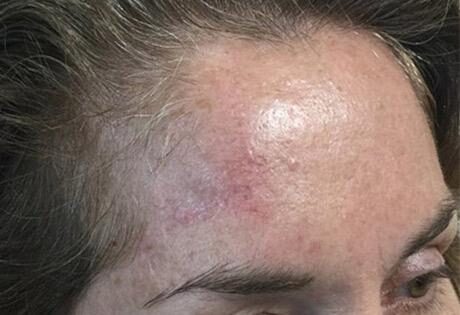 Case # 5 after photo