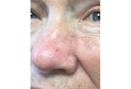 Case # 11 after photo