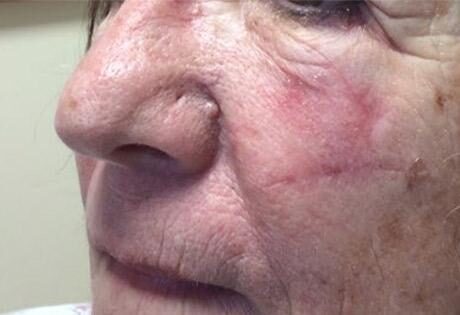 Case # 13 after photo