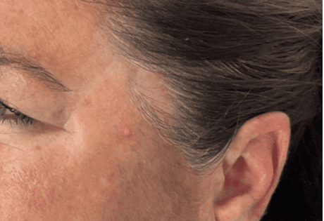 Case # 29 after photo