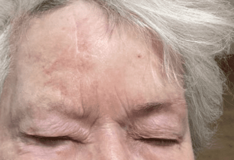 Case # 30 after photo