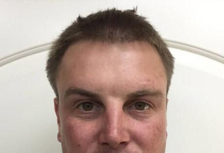 Case # 1 after photo