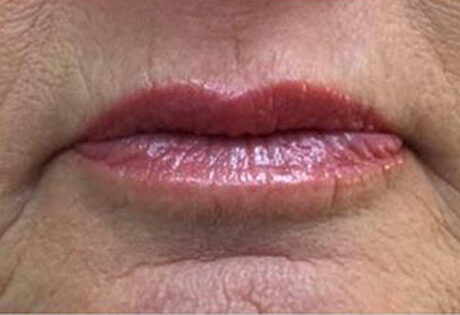 Case # 1 after photo