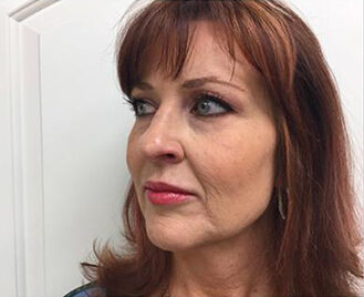 Case # 5 before photo