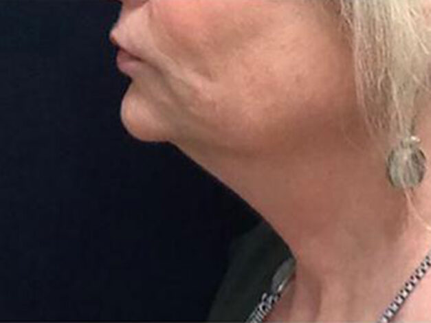 Case # 1 before photo