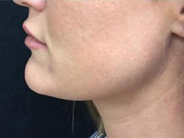 Case # 2 after photo