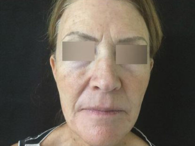 Case # 4 after photo