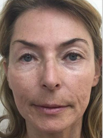 Case # 6 after photo