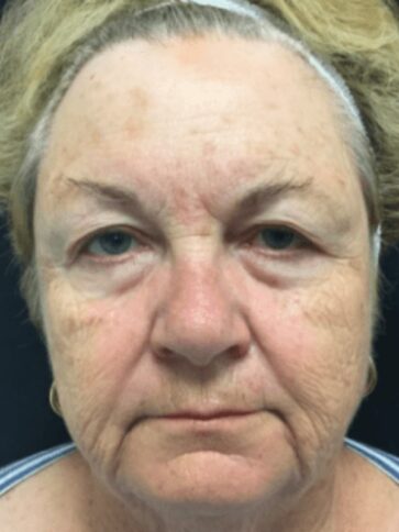 Case # 7 before photo