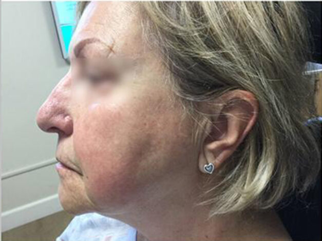 Case # 6 after photo