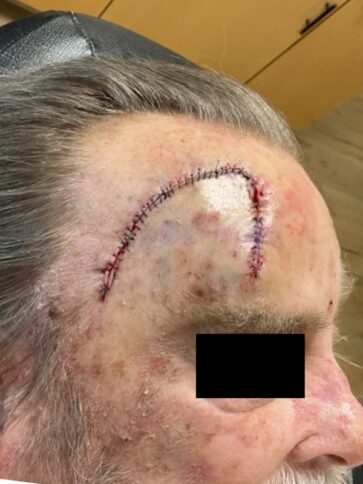 Case # 41 after photo